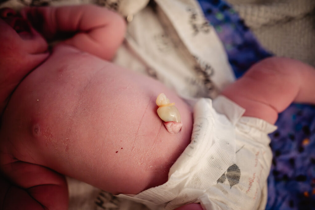 Cut umbilical cord after homebirth